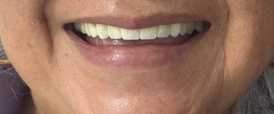 Antes de estética dental